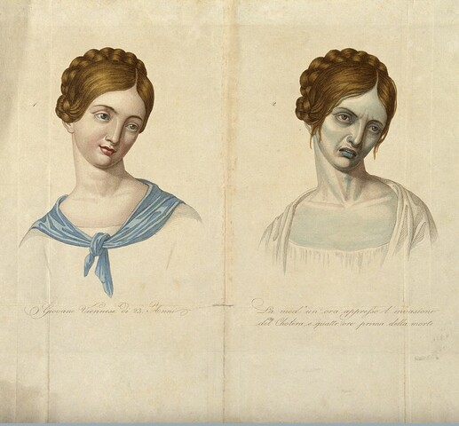 Two side by side images: one of a healthy woman, the other of the same woman after contracting cholera. The sick woman has a bluish tint to her skin which was caused by the dehydration that cholera causes.